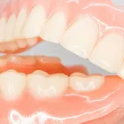 入歯